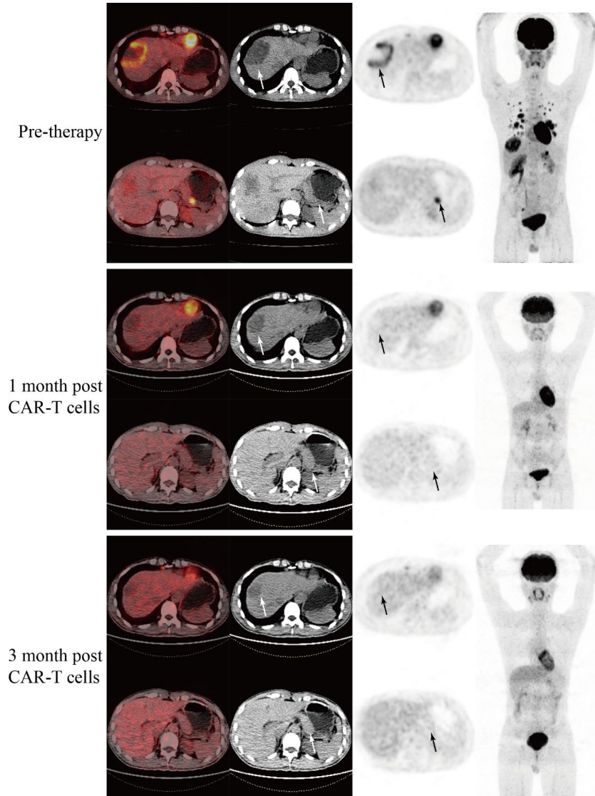 Objective Response Rate Reaches 80%! GCC19CAR-T Brings New Hope to Patients with Advanced Colorectal Cancer