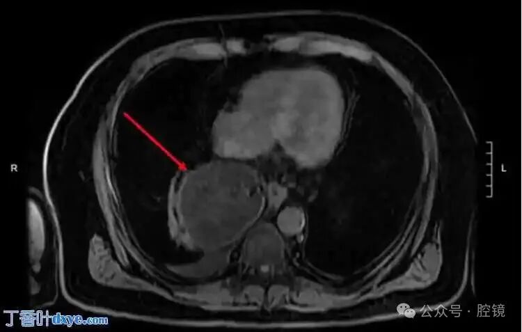 Successful Repair of a Rare Esophageal Hiatal Hernia Case Using Robotic-Assisted Surgery
