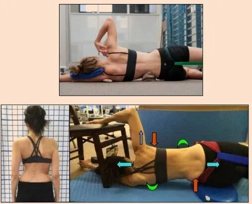 Introduction of Barcelona BSPTS: A New International Solution for Scoliosis Correction