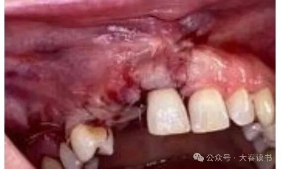 Literature Review: Application of Customized 3D-Printed Titanium Mesh in Complex Bone Defects after Odontectomy in the Aesthetic Zone: A Case Report
