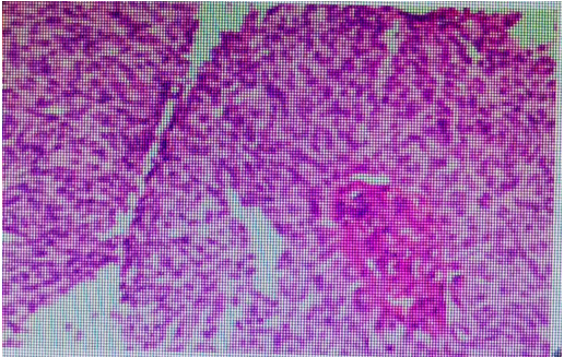 Case Sharing | The Combination of Surgery, Radiotherapy, ADC, and Immunotherapy for High-Risk Invasive Urothelial Carcinoma