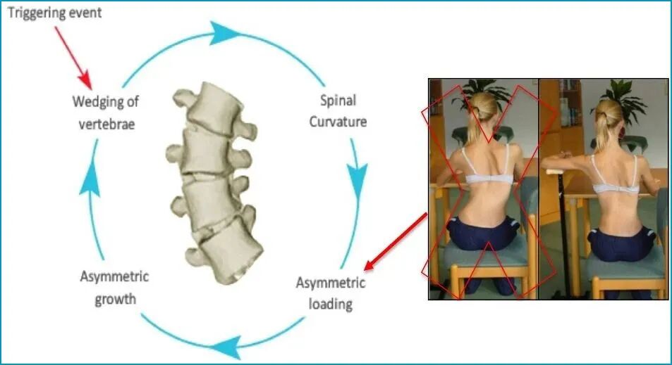 Introduction of Barcelona BSPTS: A New International Solution for Scoliosis Correction