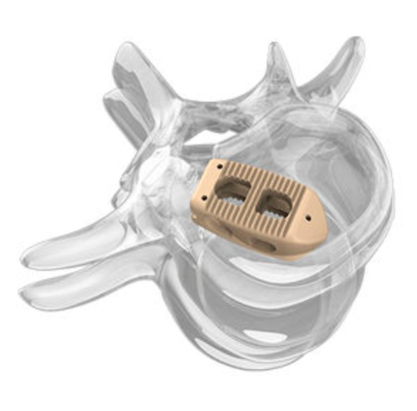 Upgrading Orthopedic Implant Technology: 3D Printing, Biodegradable Materials, and Robotic Navigation Forming a New Triangle