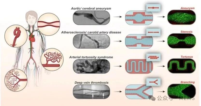 Customized Vascular Chips Simulating Real Vascular Structures to Aid Vascular Disease Research
