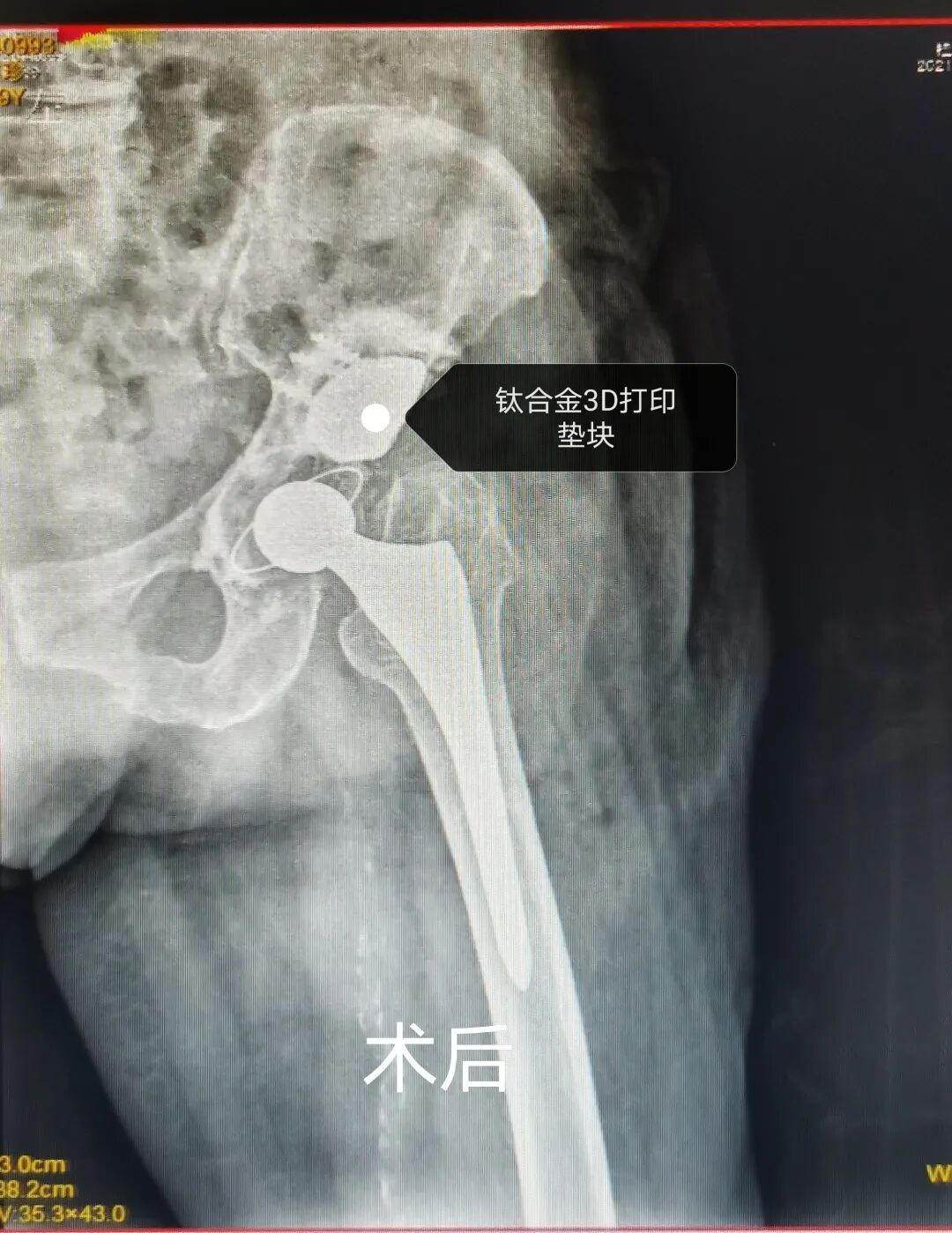 3D Printing Technology Assists 92-Year-Old Patient in Complex Surgery and Rapid Recovery