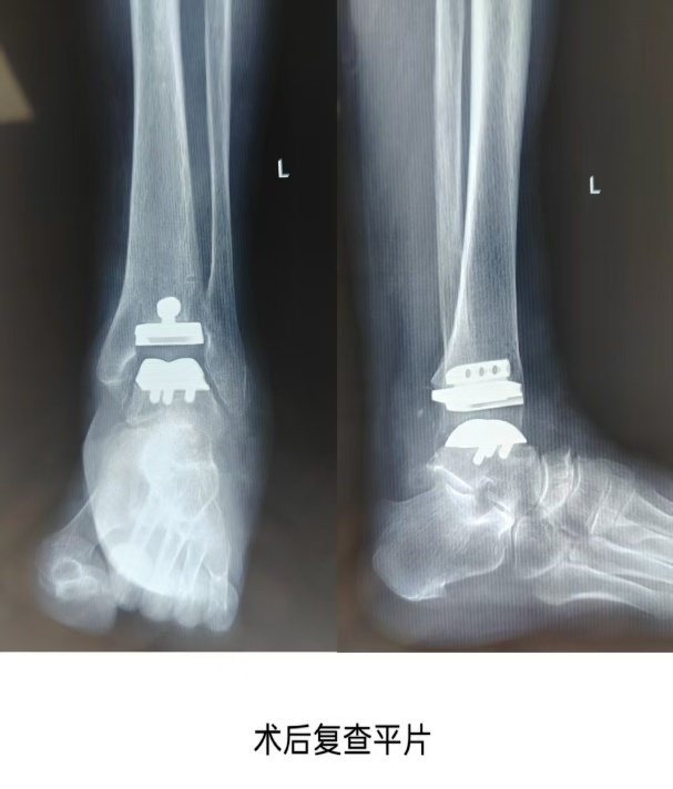 Case Study: Lixian Traditional Chinese Medicine Hospital Orthopedics Performs "3D Printed Guide-Assisted Total Ankle Joint Replacement Surgery"