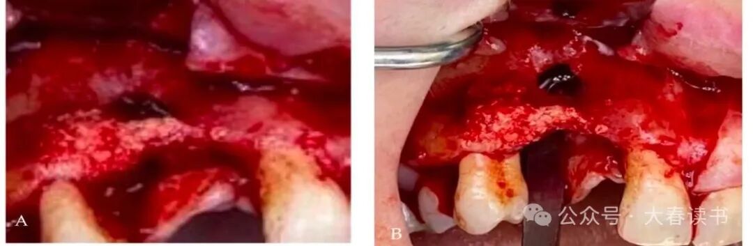 Literature Review: Application of Customized 3D-Printed Titanium Mesh in Complex Bone Defects after Odontectomy in the Aesthetic Zone: A Case Report