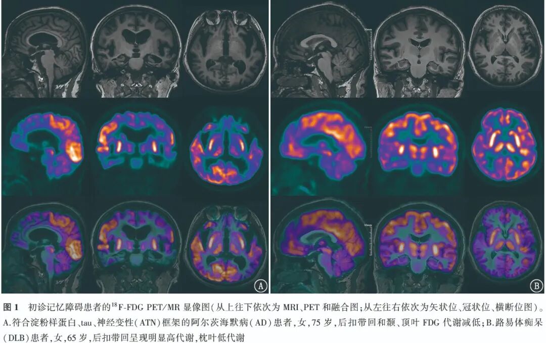 The Efficacy of 18F-FDG PET in Diagnosing Alzheimer's Disease in Patients with Memory Impairment