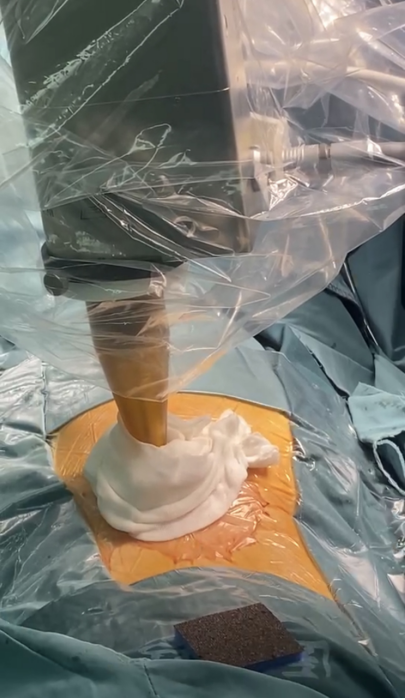 Case Sharing | The Combination of Surgery, Radiotherapy, ADC, and Immunotherapy for High-Risk Invasive Urothelial Carcinoma