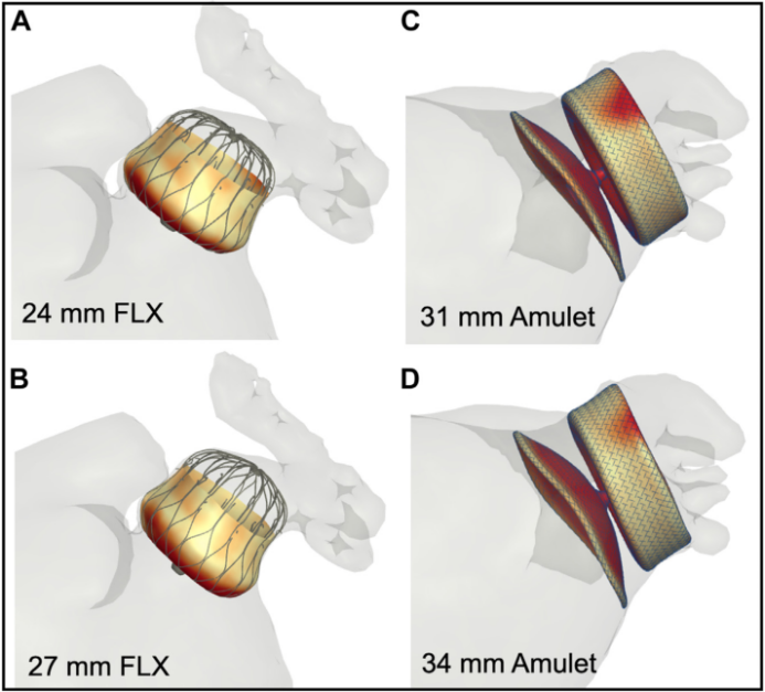 Comprehensive Review: Left Atrial Appendage Occlusion - Progress and Challenges