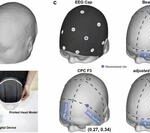 New Advances in Clinical Targeting Methods for TMS Treatment of Depression by Zhu Chaozhe's Research Group