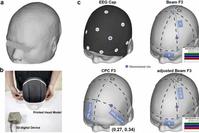 New Advances in Clinical Targeting Methods for TMS Treatment of Depression by Zhu Chaozhe's Research Group