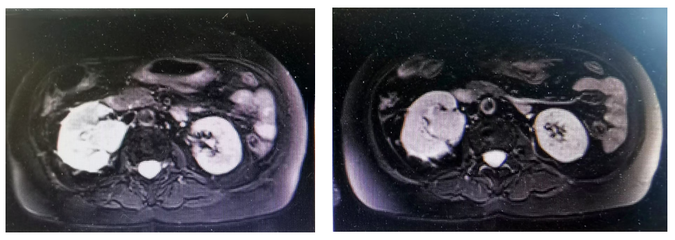 Case Sharing | The Combination of Surgery, Radiotherapy, ADC, and Immunotherapy for High-Risk Invasive Urothelial Carcinoma