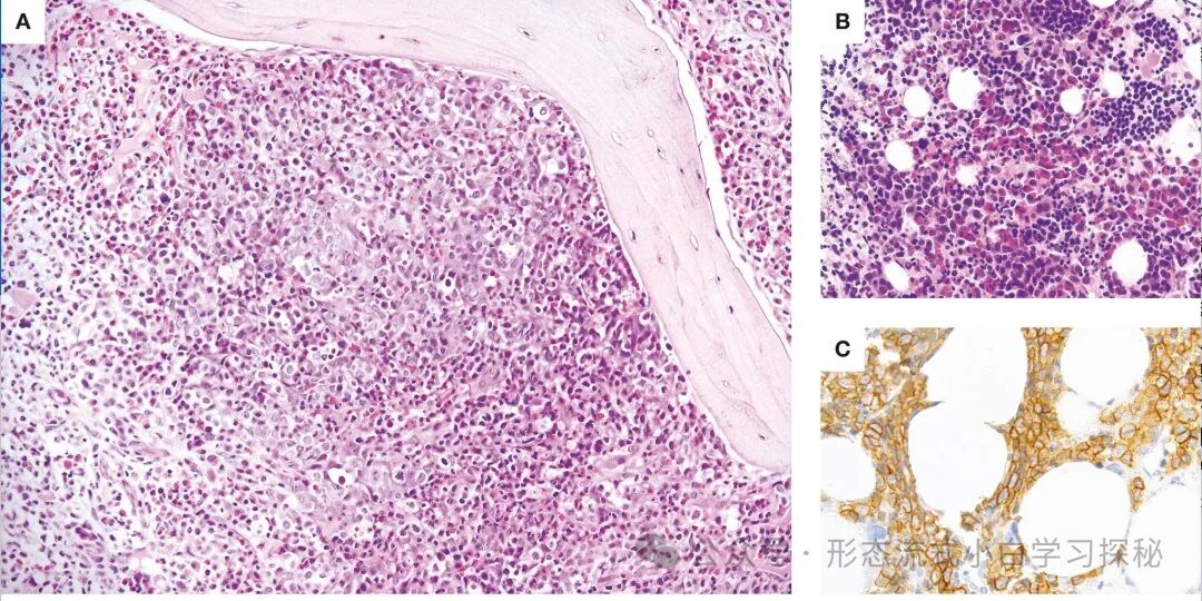 Chapter 6 of ICC: Myeloid/Lymphoid Neoplasms with Eosinophilia and Tyrosine Kinase Gene Fusions (M/LN-eo-TK)
