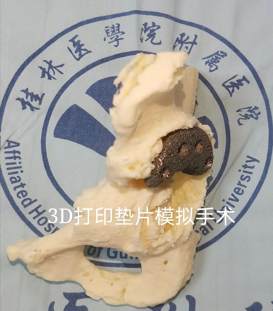 3D Printing Technology Assists 92-Year-Old Patient in Complex Surgery and Rapid Recovery