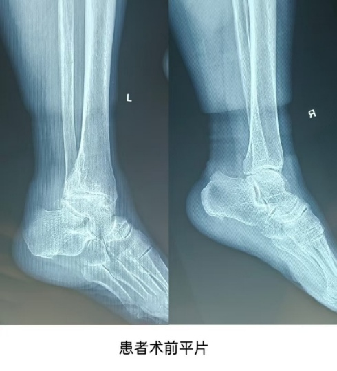 Case Study: Lixian Traditional Chinese Medicine Hospital Orthopedics Performs "3D Printed Guide-Assisted Total Ankle Joint Replacement Surgery"
