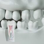 Bone Grafting Treatment for Periodontitis: 3D Printed Bone Grafting Technology