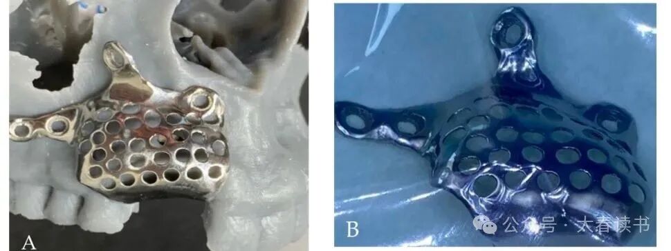 Literature Review: Application of Customized 3D-Printed Titanium Mesh in Complex Bone Defects after Odontectomy in the Aesthetic Zone: A Case Report