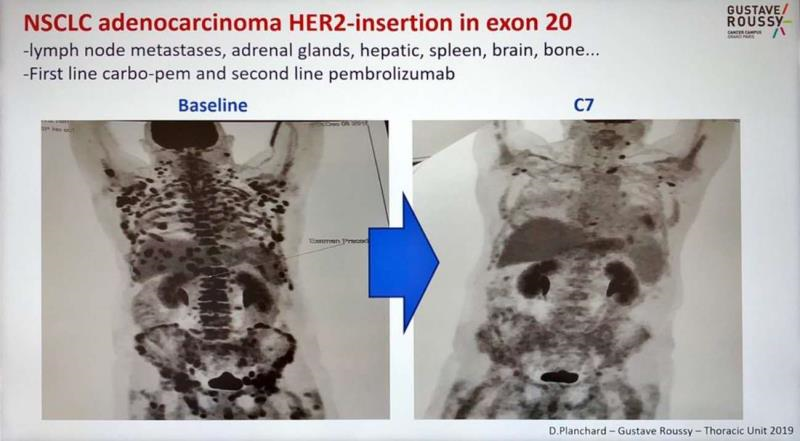 A Detailed Explanation of ADC: How ADC is Reshaping Clinical Guidelines? A New Era in Lung Cancer Treatment