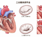 Transcatheter Minimally Invasive Treatment of Atrial Functional Mitral Regurgitation
