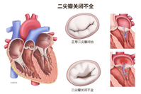 Transcatheter Minimally Invasive Treatment of Atrial Functional Mitral Regurgitation