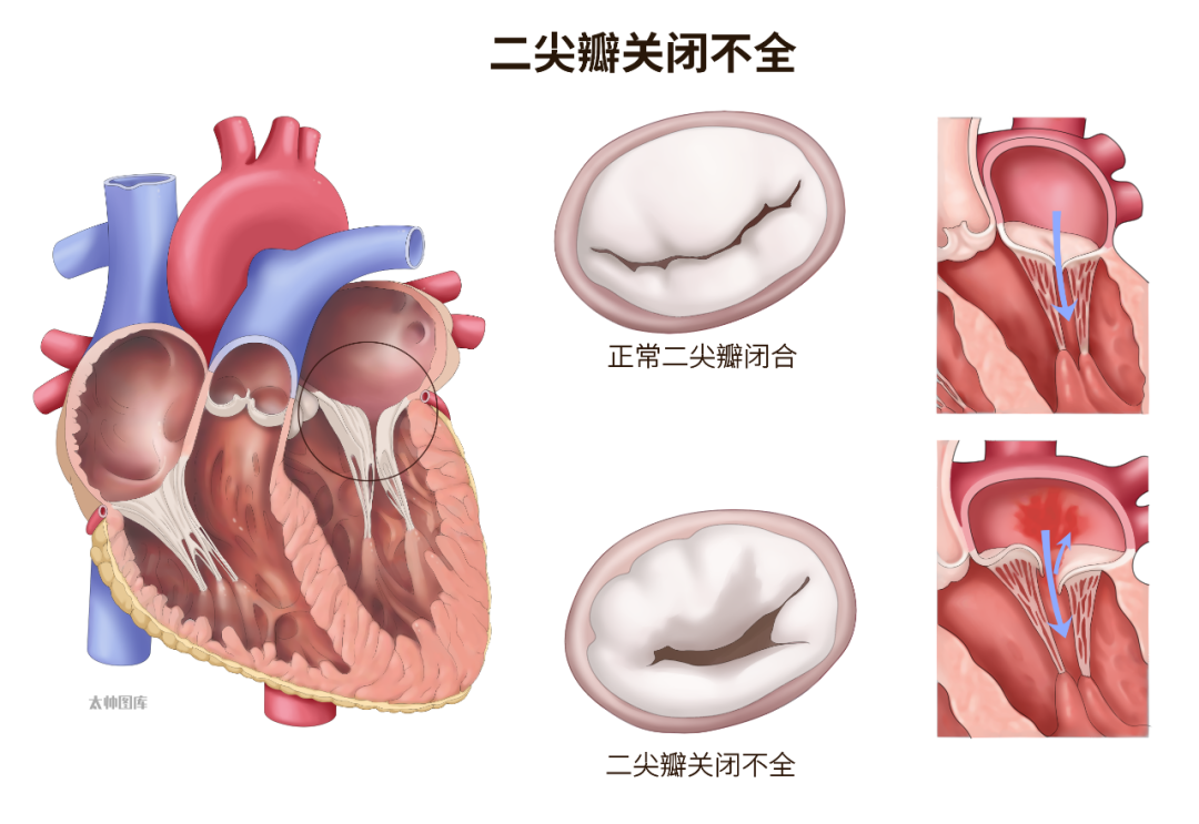 Transcatheter Minimally Invasive Treatment of Atrial Functional Mitral Regurgitation