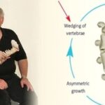 Introduction of Barcelona BSPTS: A New International Solution for Scoliosis Correction