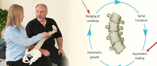 Introduction of Barcelona BSPTS: A New International Solution for Scoliosis Correction