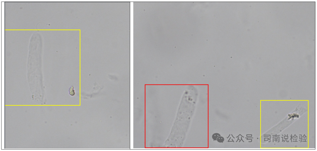 Morphology 121: Urine - Transparent Casts (Instrument-Assisted Diagnosis)