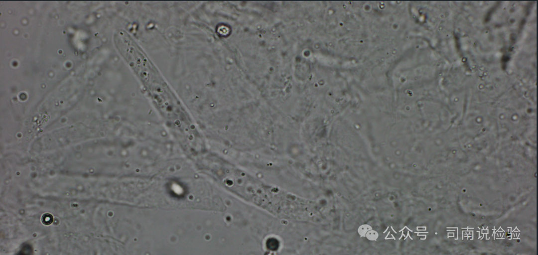 Morphology 121: Urine - Transparent Casts (Instrument-Assisted Diagnosis)