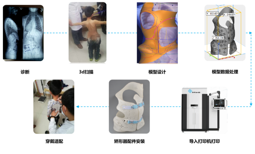 3D Printed Scoliosis Orthosis: Technology Straightens the Spine for Adolescents