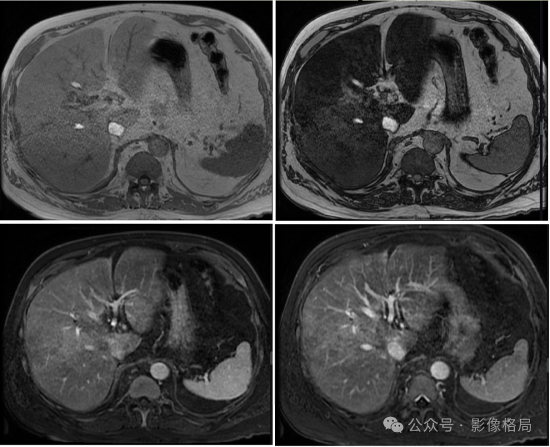 Multifocal Hepatic Steatosis