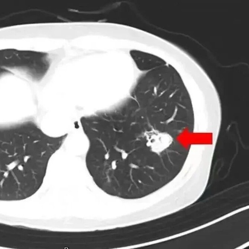High Fever of 40°C After Spring Cleaning: Beware of Mold in the Lungs!
