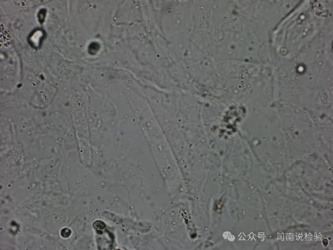 Morphology 121: Urine - Transparent Casts (Instrument-Assisted Diagnosis)