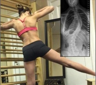 Introduction of Barcelona BSPTS: A New International Solution for Scoliosis Correction