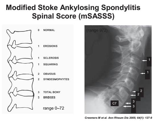 The History of Ankylosing Spondylitis/Axial Spondyloarthritis – What Drives New Knowledge?