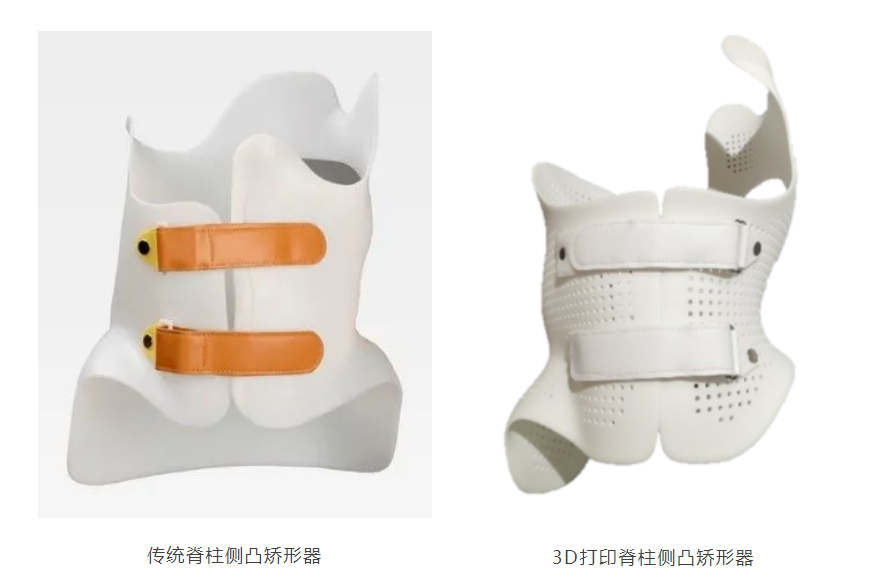 3D Printed Scoliosis Orthosis: Technology Straightens the Spine for Adolescents