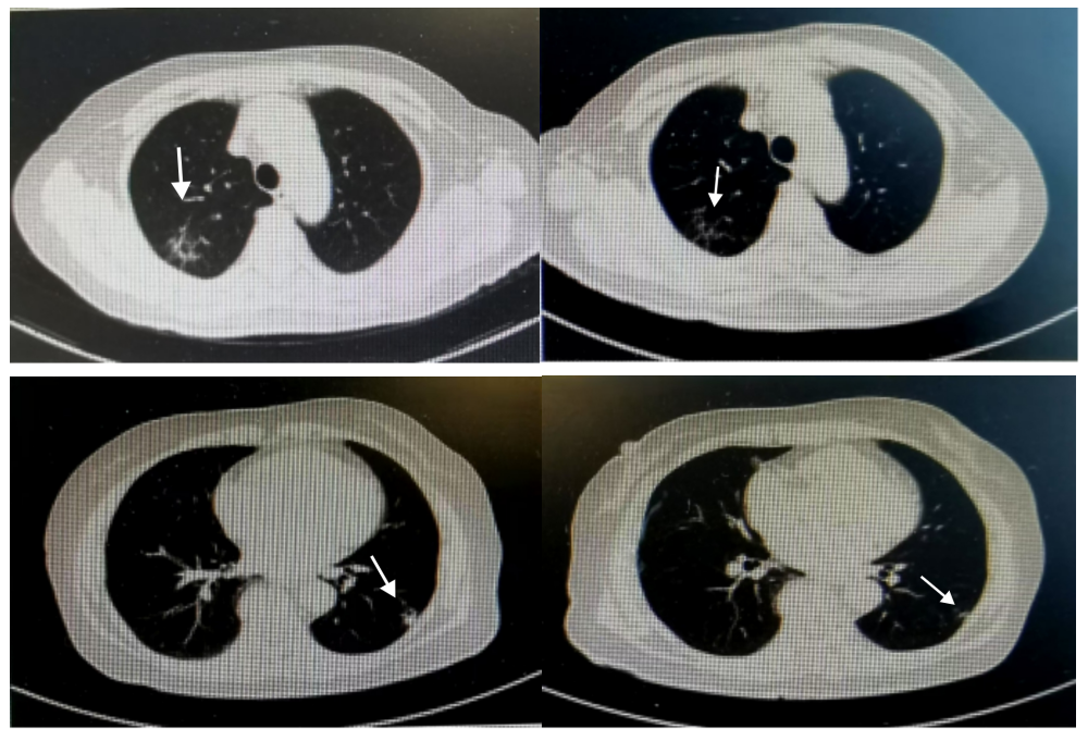 Case Sharing | The Combination of Surgery, Radiotherapy, ADC, and Immunotherapy for High-Risk Invasive Urothelial Carcinoma
