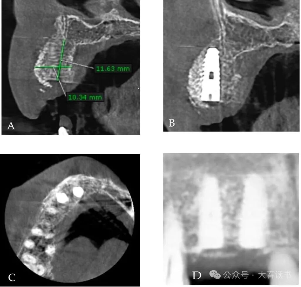 Literature Review: Application of Customized 3D-Printed Titanium Mesh in Complex Bone Defects after Odontectomy in the Aesthetic Zone: A Case Report
