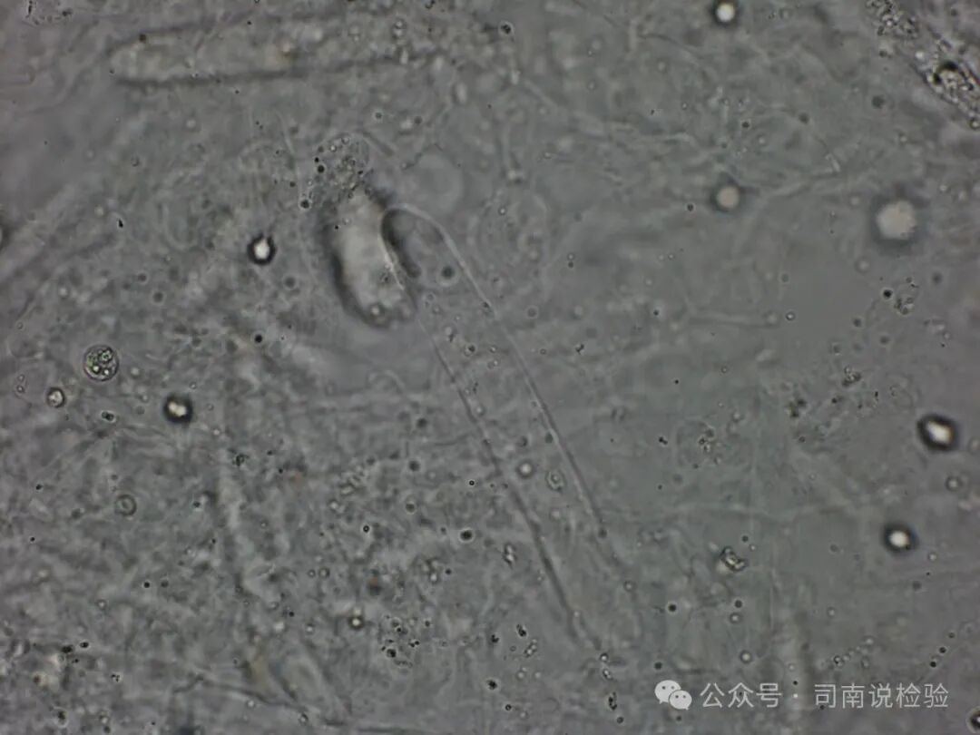 Morphology 121: Urine - Transparent Casts (Instrument-Assisted Diagnosis)