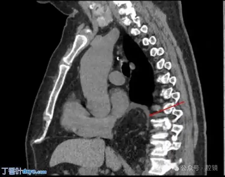 Successful Repair of a Rare Esophageal Hiatal Hernia Case Using Robotic-Assisted Surgery