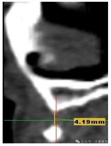 Literature Review: Application of Customized 3D-Printed Titanium Mesh in Complex Bone Defects after Odontectomy in the Aesthetic Zone: A Case Report