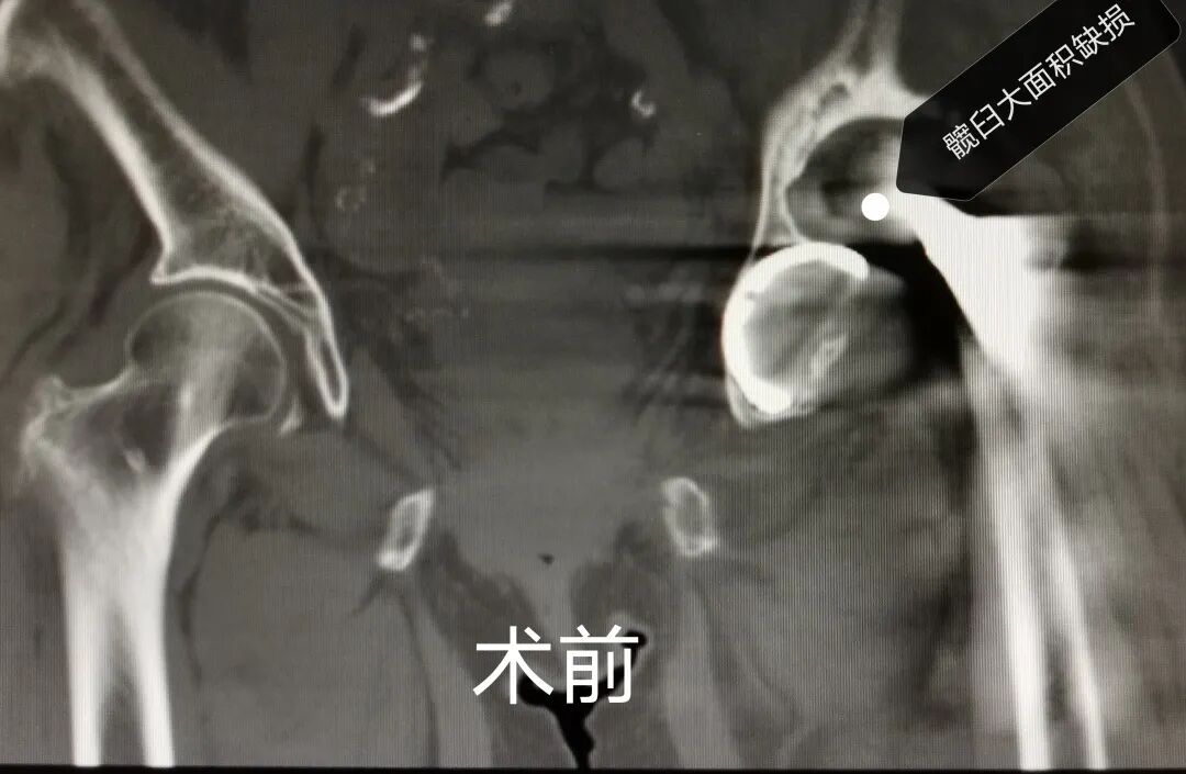 3D Printing Technology Assists 92-Year-Old Patient in Complex Surgery and Rapid Recovery