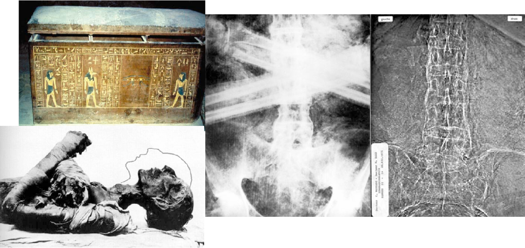 The History of Ankylosing Spondylitis/Axial Spondyloarthritis – What Drives New Knowledge?