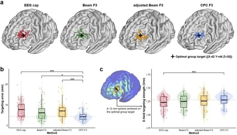 New Advances in Clinical Targeting Methods for TMS Treatment of Depression by Zhu Chaozhe's Research Group