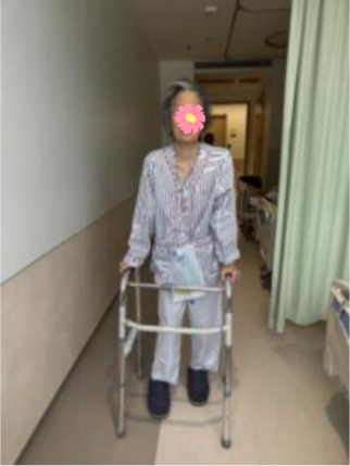 Robotic Navigation and AI for Custom Hip Joint Reconstruction: A World-First Approach to Bone Repair