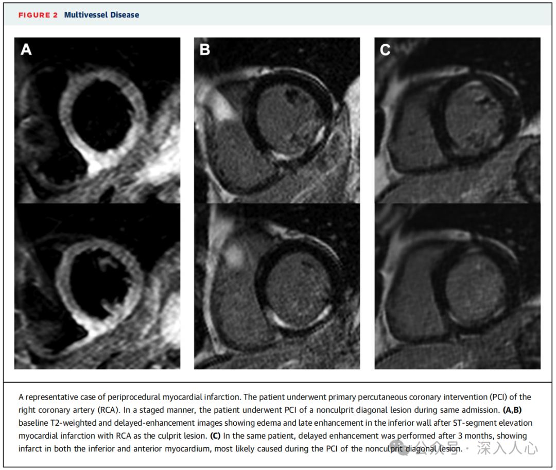 DANAMI-3-PRIMULTI Substudy—Cardiac Magnetic Resonance Confirms the Impact on Cardiac Structure and Function