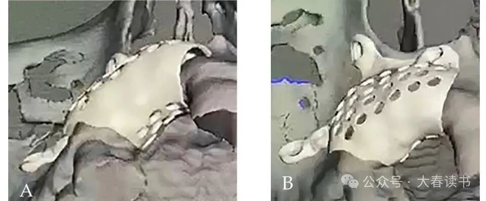 Literature Review: Application of Customized 3D-Printed Titanium Mesh in Complex Bone Defects after Odontectomy in the Aesthetic Zone: A Case Report