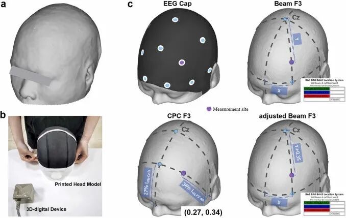 New Advances in Clinical Targeting Methods for TMS Treatment of Depression by Zhu Chaozhe's Research Group