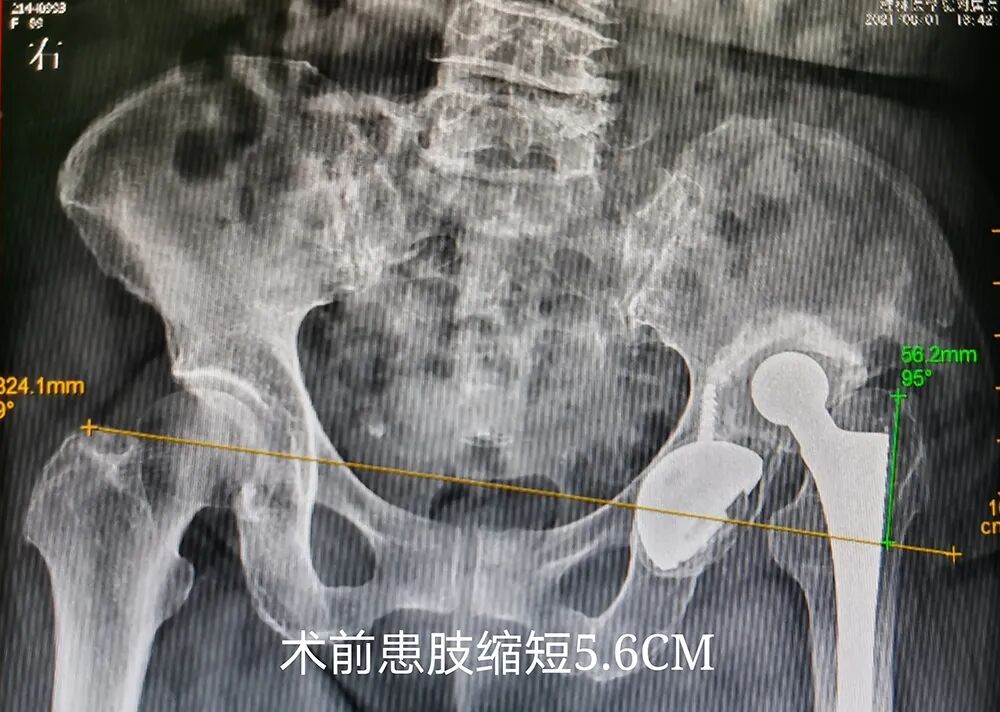 3D Printing Technology Assists 92-Year-Old Patient in Complex Surgery and Rapid Recovery